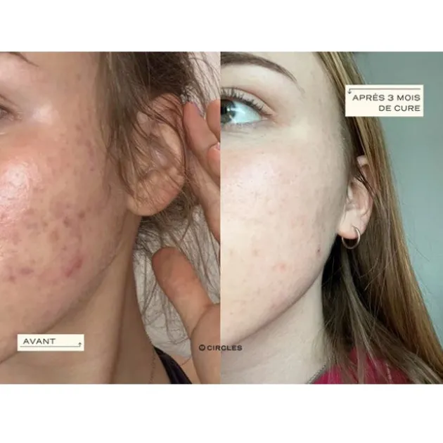 Circles Cure détox & acné hormonale CLEAR