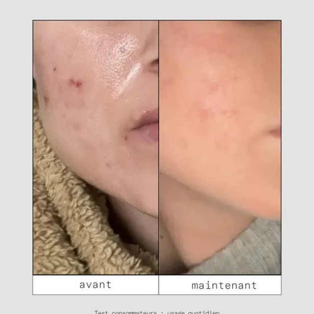 Skin & Out Mini routine spéciale boutons Minis Shtars